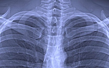 Neue Röntgenmethode für Corona-Diagnose im Test