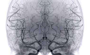 Früherkennung von Mikro-Blutgerinnseln