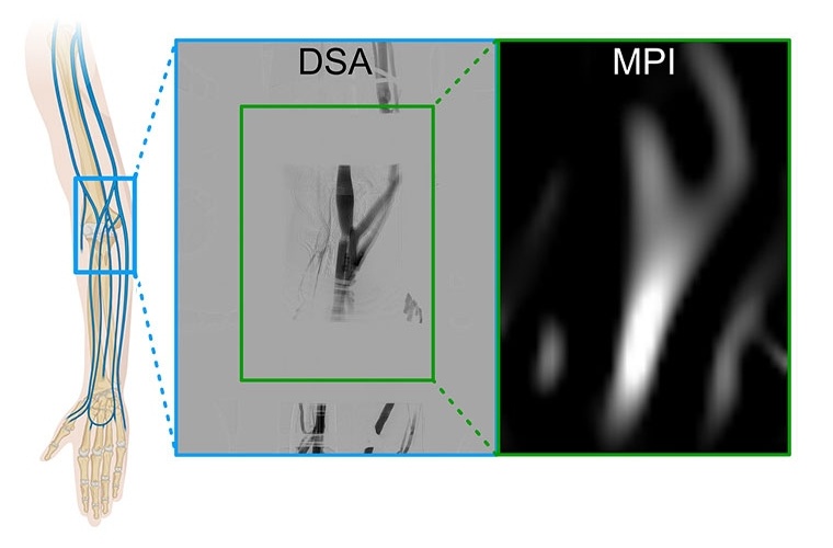 Ver­gleich von MPI-Angio­gra­phie (MPA) und Di­gi­ta­ler...