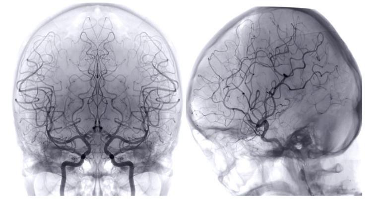 Lebenswichtiges Netz: Werden die fein vernetzten Blutbahnen im Gehirn durch...