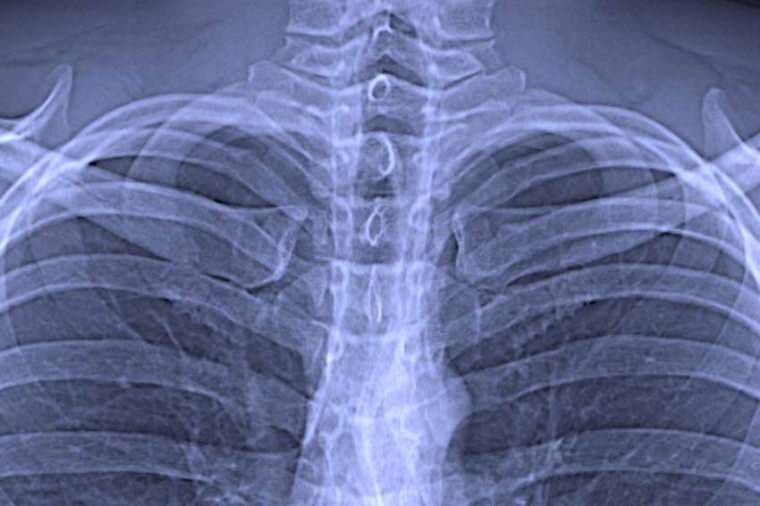 Abb.: Ausschnitt aus einer konventionellen Röntgenaufnahme des Brustkorbs....