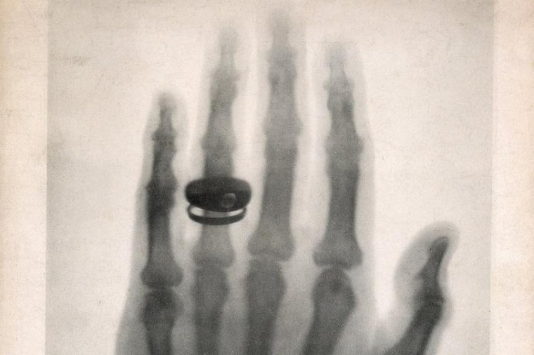 Abb.: Eine der ersten Röntgen­aufnahmen: die Hand des Anatomen Geheimrath von...